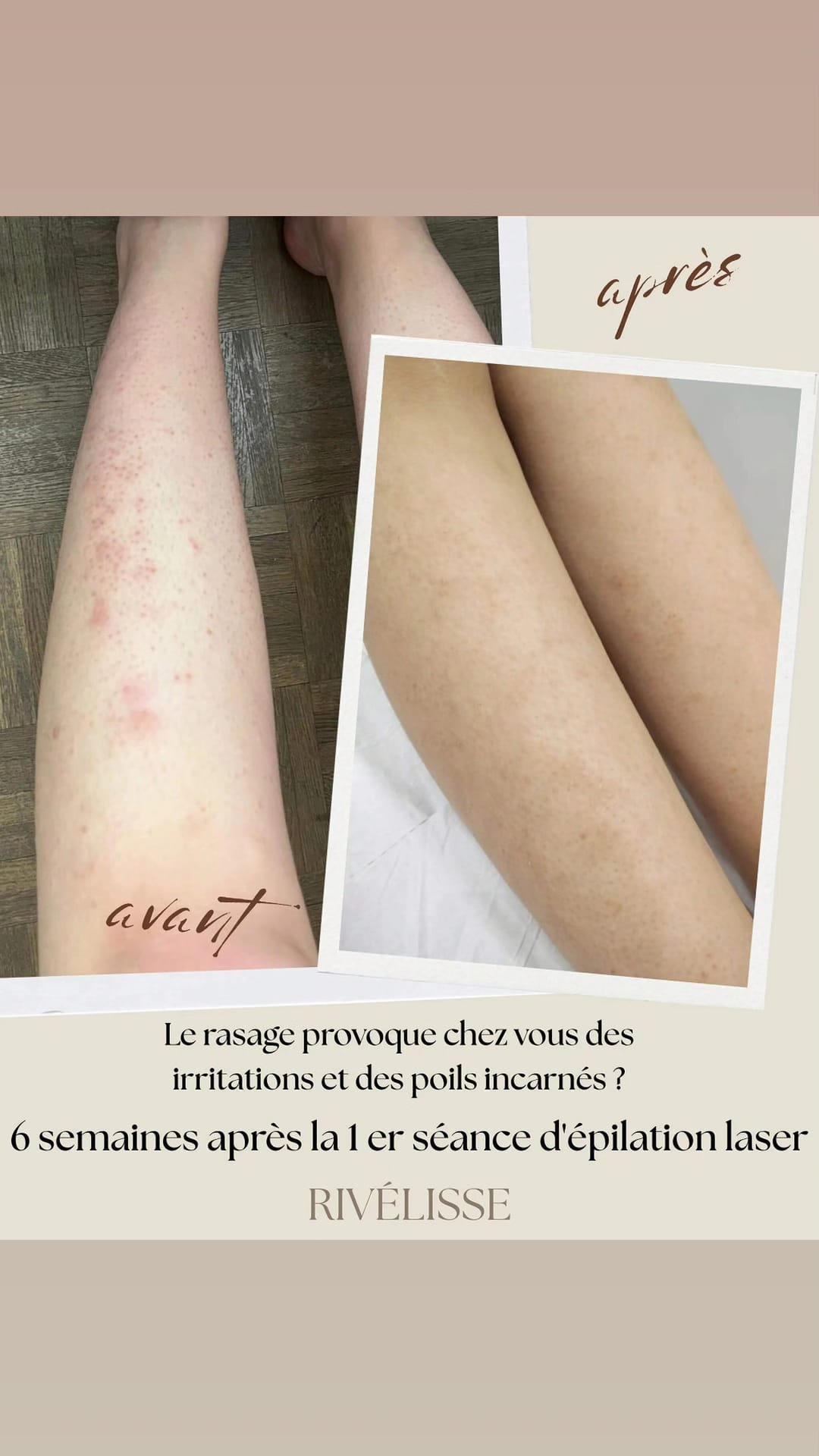 Résultat épilation laser jambe 6 semaines après la première séance Rivélisse